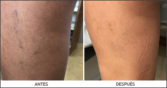 Imagen de Telangiectasia en la pierna antes y después de la operación
